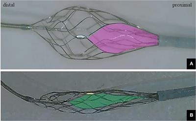 Combining the deployment of only the distal basket segment of the EMBOTRAP III and an aspiration catheter for M2 occlusions: the ONE-SEG technique